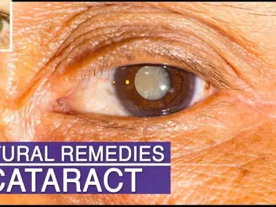 Cataracts - Understanding the clouding of the lens