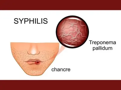Chancroid - Sexually transmitted diseases cause pain