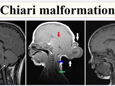 Living with a chiari malformation - A patient's guide