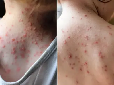 Chickenpox symptoms and how it spreads in children