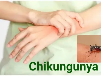 Chikungunya symptoms causes and treatment explained