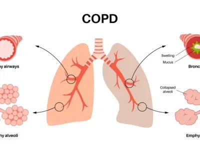 Chronic obstructive pulmonary disease - A guide to copd