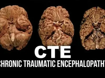 Chronic traumatic encephalopathy - The hidden risks
