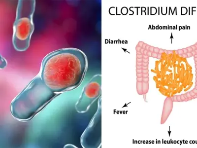 C. difficile infection - The danger of antibiotic-use diarrhea