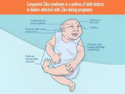 Infectious congenital zika syndrome causes prevention tips
