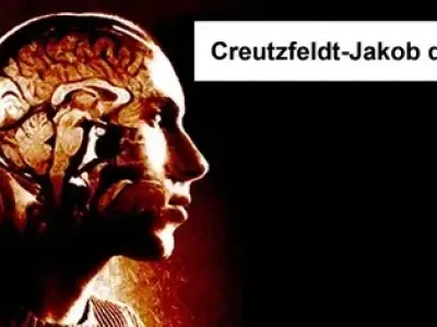 Creutzfeldt-jakob disease (CJD) - An expert guide