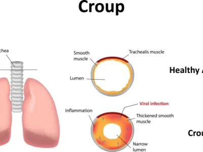 Understanding croup symptoms in children and adults
