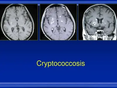 Why the immunocompromised are at high risk for cryptococcosis