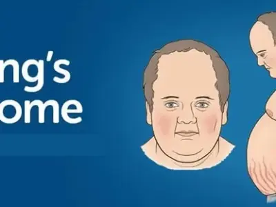 Cushing's syndrome - Recognizing the signs of high cortisol