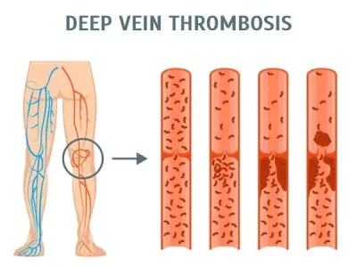 Deep Vein Thrombosis (DVT) essential patient facts