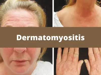 Dermatomyositis - What you need to know about this condition?