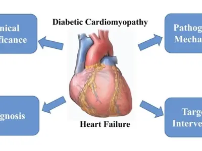 Diabetic cardiomyopathy causes symptoms and treatment