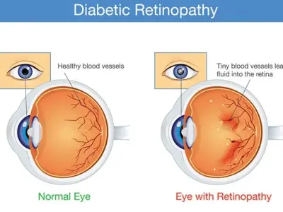 Diabetic retinopathy - A leading cause of blindness