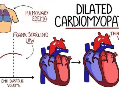 Symptoms and warning signs of dilated cardiomyopathy (DCM)