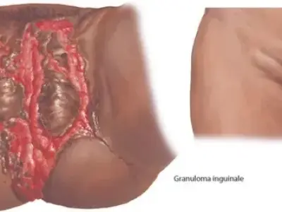 How donovanosis is diagnosed and treated with antibiotics