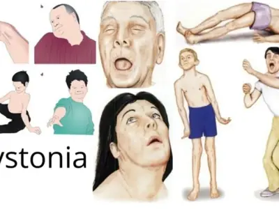 How is dystonia diagnosed and effectively treated?