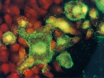 Echovirus infection - A common virus with many faces