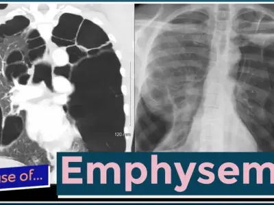 Emphysema - Understanding this progressive lung disease