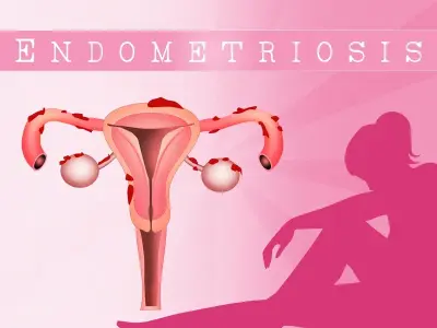 Endometriosis - Understanding this painful, complex disorder