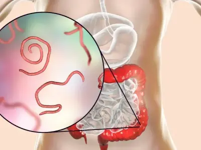 How to treat severe itching caused by Enterobiasis infection