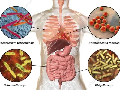 Enterococcus infection - A common bug in hospital settings