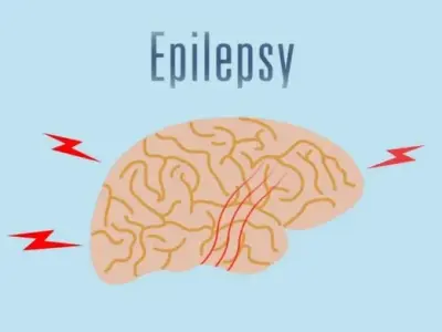 First aid for seizures - How to help someone with epilepsy