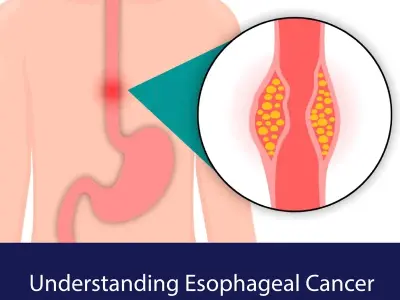 Esophageal cancer - Understanding the major types and causes