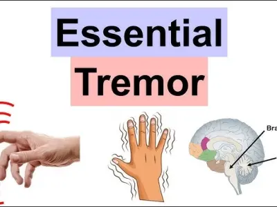 Understanding the causes and symptoms of essential tremor