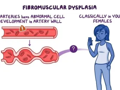 Fibromuscular Dysplasia (FMD) what patients should know