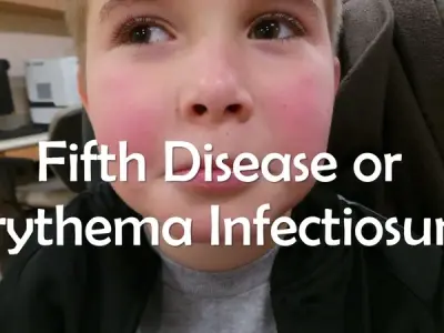 Unmasking fifth disease - What you need to know?