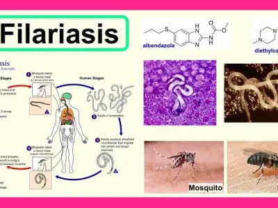 Chronic filariasis treatment options - Expert advice