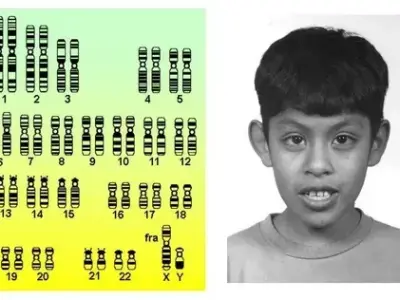 Fragile X syndrome - The leading inherited cause of ID