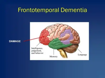 Frontotemporal dementia - A comprehensive guide