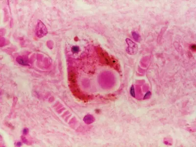 Oral hygiene's role in preventing fusospirochetal disease