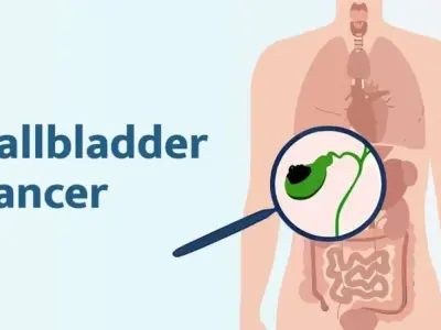 Gallbladder Cancer - Stages of disease development