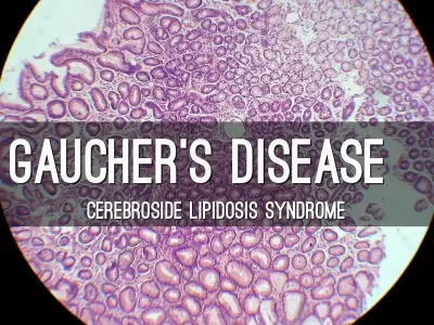 Gaucher disease - An inherited lysosomal storage disorder