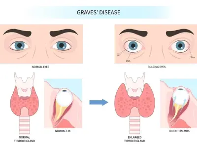 Understanding the autoimmune attack in Graves' disease