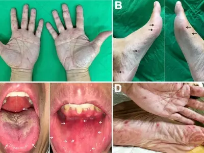 Hand, foot, and mouth disease symptoms in kids