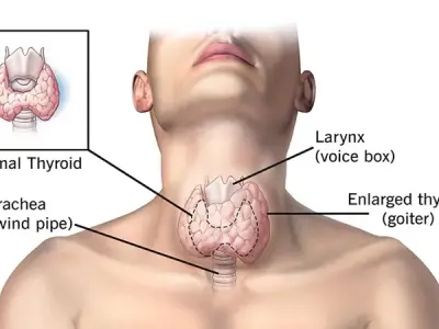 Hashimoto's thyroiditis - The autoimmune cause of hypothyroidism