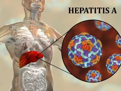 Hepatitis A - What to do after a hepatitis a exposure