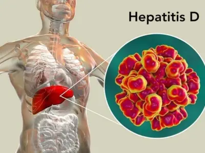 Understanding hepatitis D causes symptoms and treatment