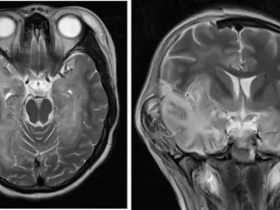 Understanding herpes simplex encephalitis causes and risk