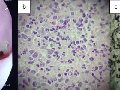 Histoplasmosis diagnosis - The most standard treatment