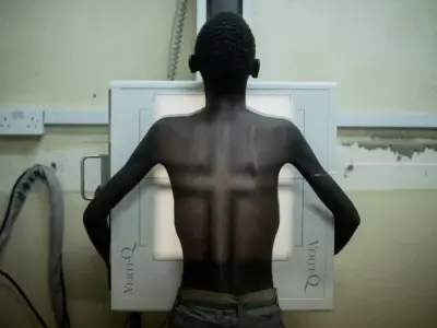 Human immunodeficiency virus - PrEP and prevention