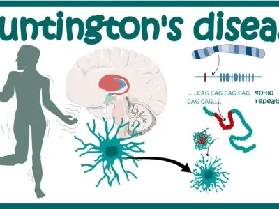 What is Huntington's disease? What are the early signs?