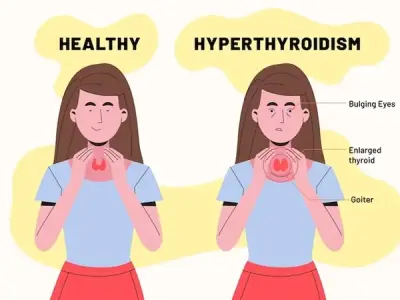 Hyperthyroidism explained - Your guide to an overactive thyroid