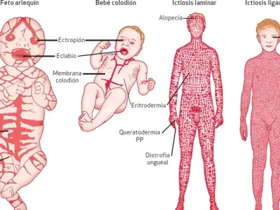 Ichthyosis - understanding inherited dry skin disorders