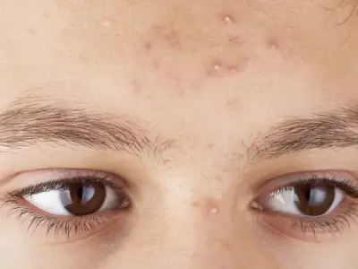 Differentiating between bullous and non-bullous impetigo