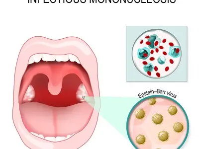 Managing fatigue in chronic infectious mononucleosis