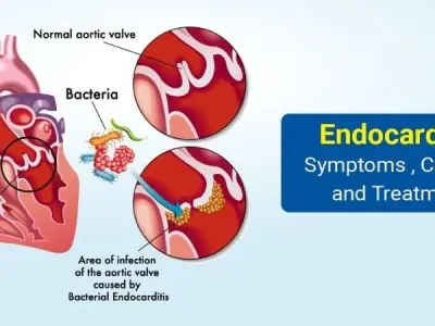 Infective Endocarditis risk factors and early warning